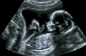 An ultrasound scan