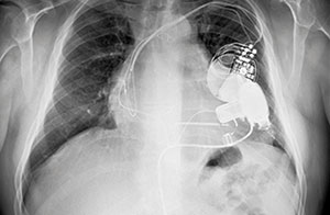X-ray of pacemaker and heart pump