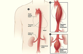 Thoracic aortic aneurysm and abdominal aortic aneurysm illustration