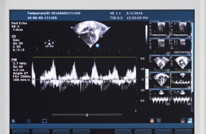 An ultrasound machine used for an echocardiogram