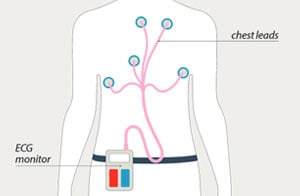 24-hour ECG monitor illustration