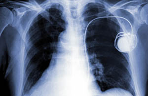 An x-ray image showing someone with a pacemaker 
