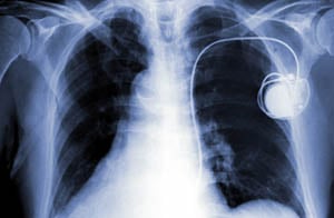An x-ray image showing someone with a pacemaker An x-ray image showing someone with a pacemaker