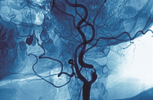 Angiogram showing a narrowed neck artery due to carotid artery disease 