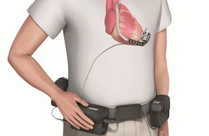 lvad