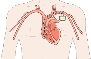 Implantable cardioverter defibrillator