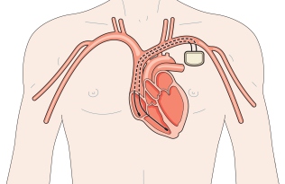 Implantable cardioverter defibrillator