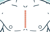 Coronary Artery Bypass Grafting scar