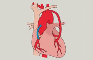 Coronary Artery Bypass Grafting illustration
