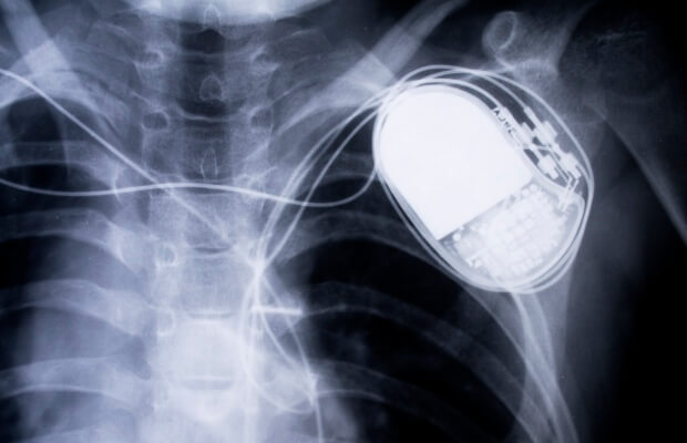 Pacemaker on an x-ray