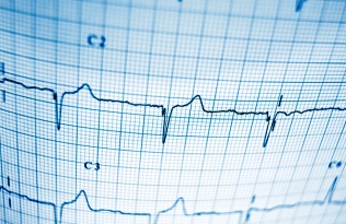 ECG chart