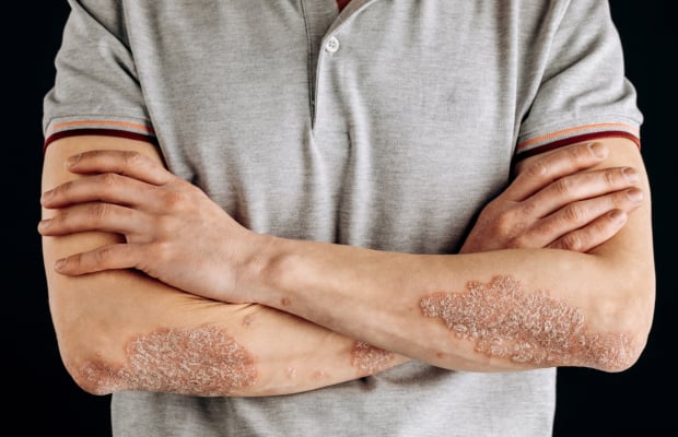 A man's folded arms with large red, inflamed, flaky rash on the elbows.