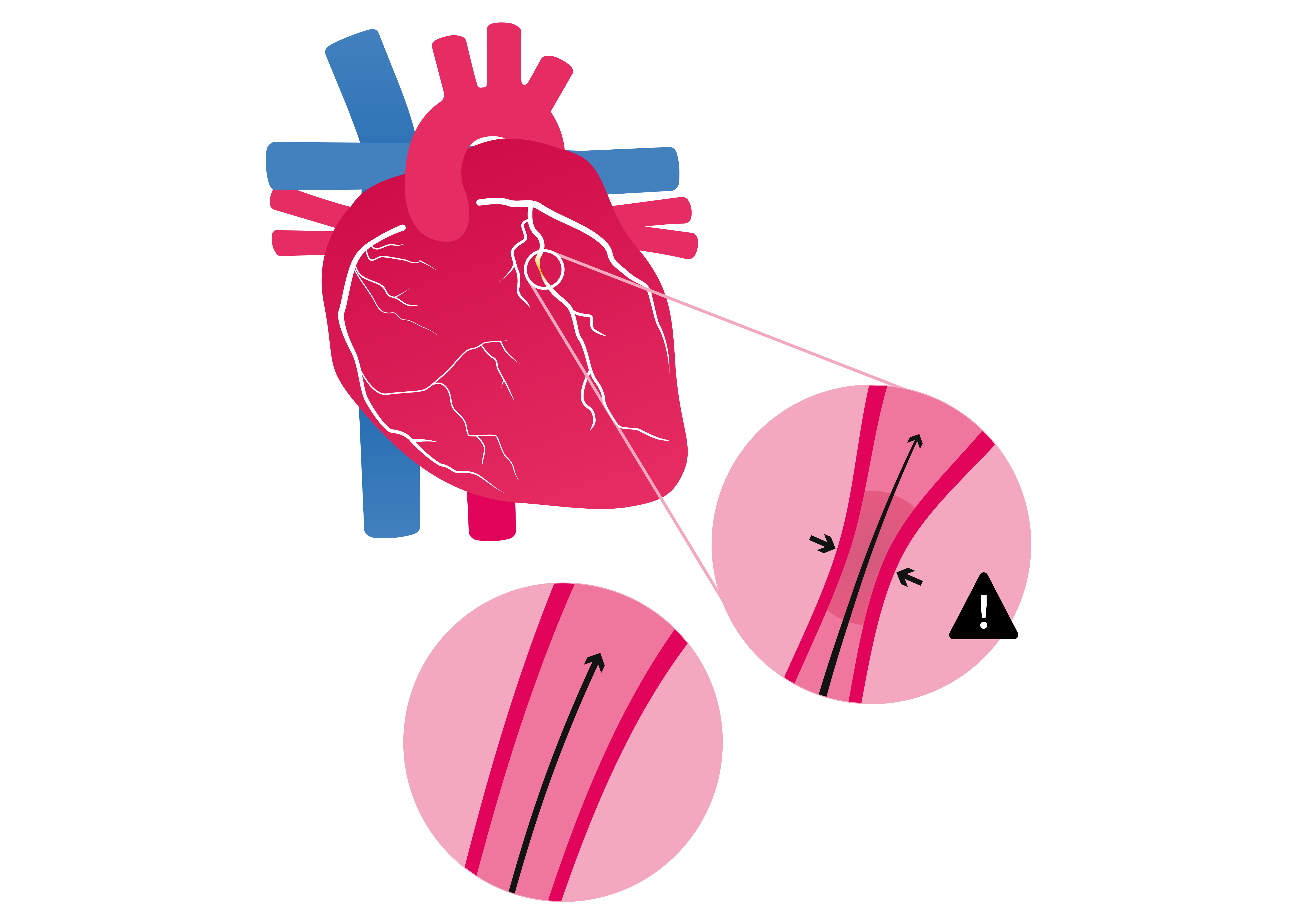 Angina Visual Angina - Causes, symptoms & treatments - BHF