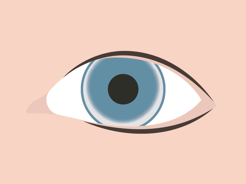 Corneal arcus, eye with high cholesterol