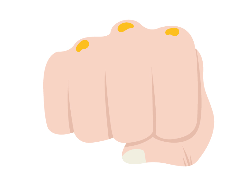 Tendon xanthomata, cholesterol build up in knuckles