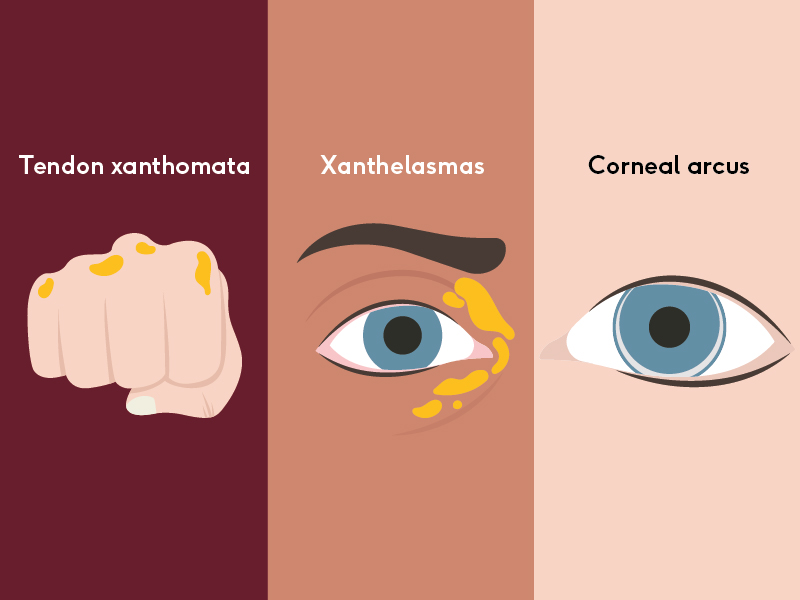 Tendon xanthomata, corneal arcus, and xanthelasmas