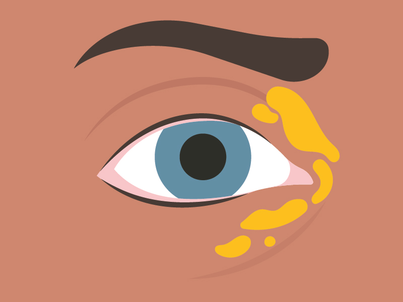 Cholesterol build up in inner eye corner, xanthelasmas