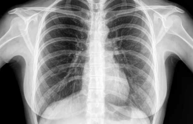 A normal chest x ray