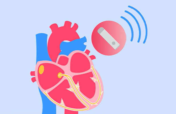 Cover of video that explains implantable loop recorders