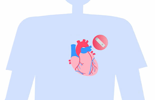 Cover of video that explains implantable loop recorders
