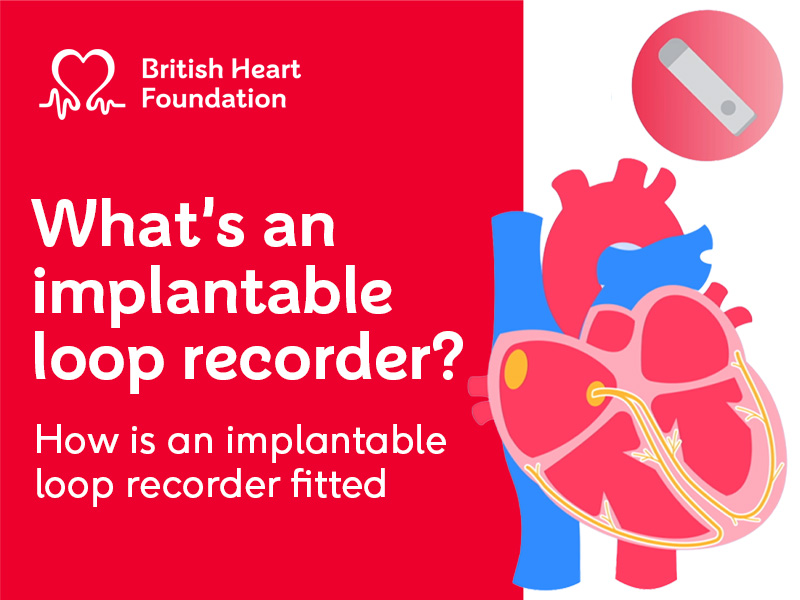 White text on red background reading "What's an implantable loop recorder? How is an implantable loop recorder fitted". With illustration of a heart with a loop recorder.