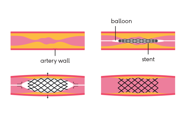 Illustration of the stent fitting process