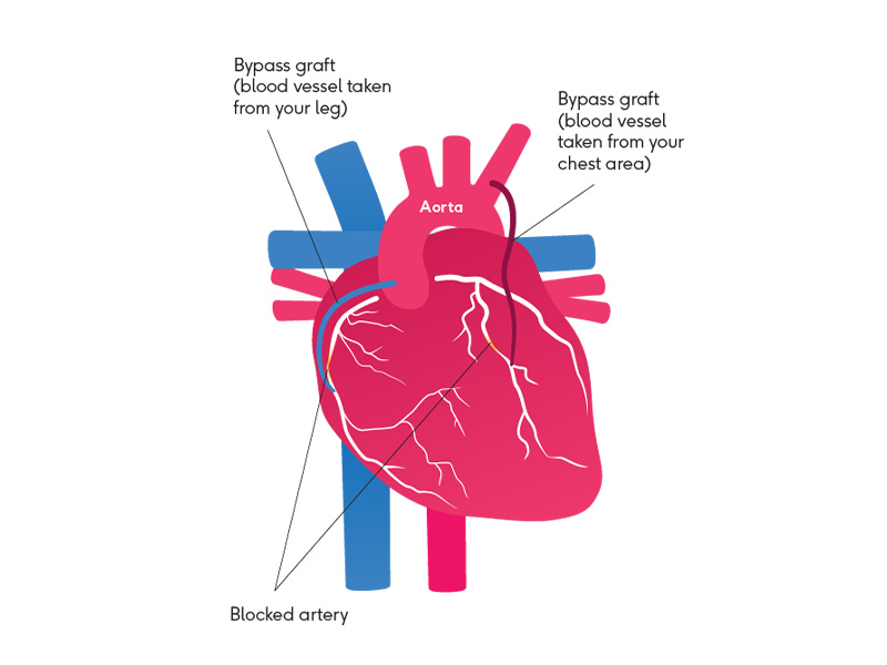 Illustration showing a heart with a bypass graft artery attached on the left and right side of the heart.