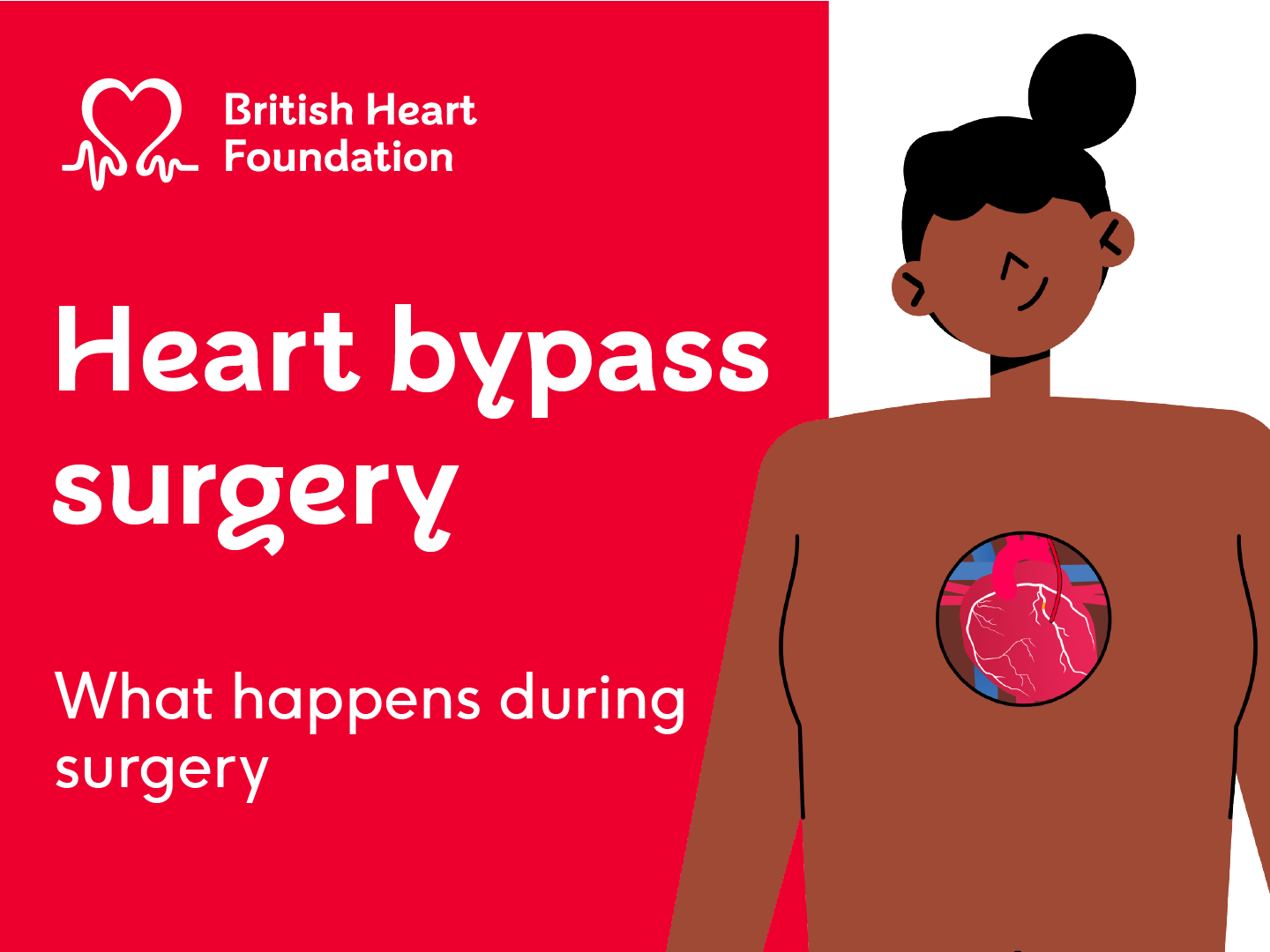 On the right side of the image is an illustration of a woman with brown skin standing on a white background. The woman has black hair and you can see her heart in her chest. On the left side is a red background with the BHF logo and text reading heart bypass surgery what happens during surgery.