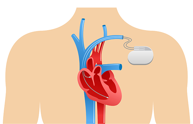 outline of a body showing a pacemaker in the chest and leads into the heart