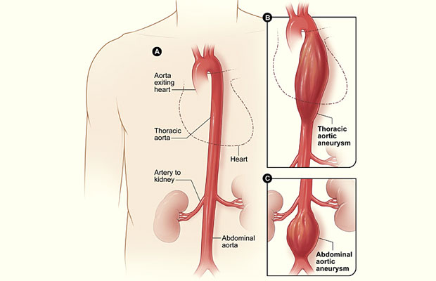 A picture showing the variations of aortic aneurysm according to where they occur.
