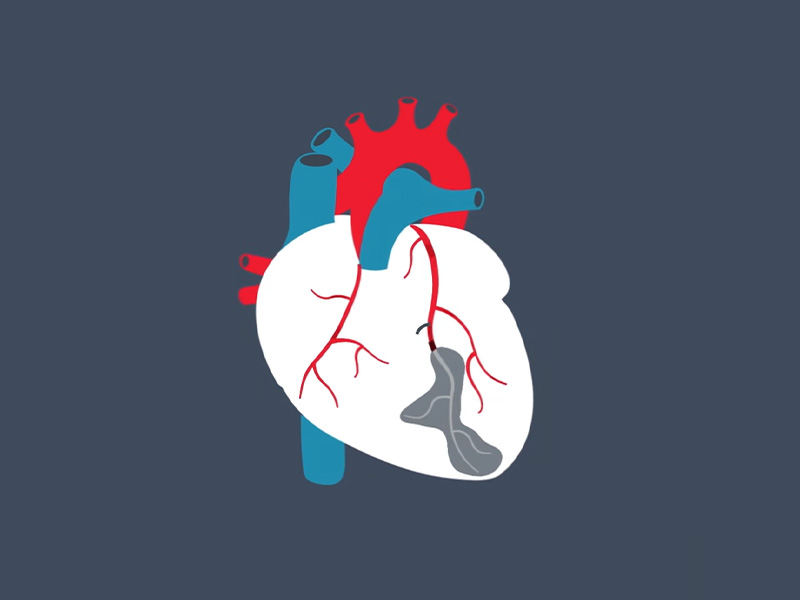 Illustration of heart with a clogged artery, also know as atherosclerosis.