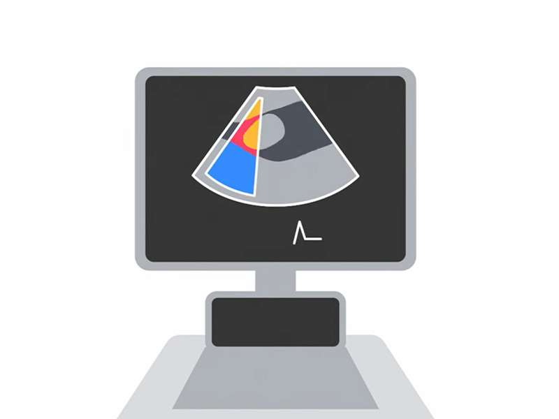 Illustration of echocardiogram