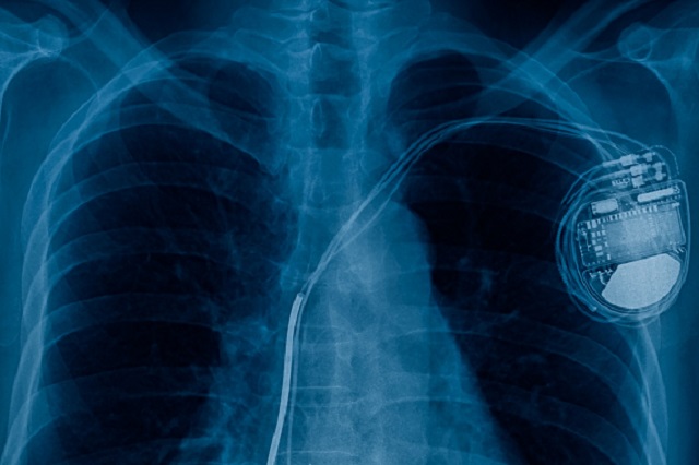 An x-ray scan of the chest with a pacemaker attached to the heart