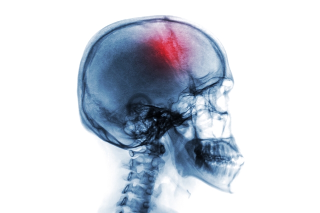 An x-ray of a stroke patient.