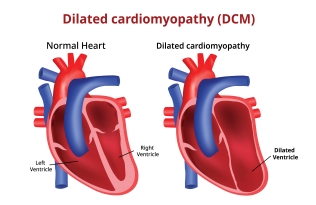 heart with dilated cardiomyopathy