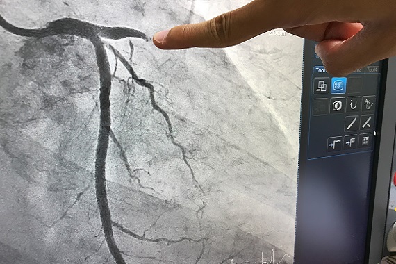 Angiogram showing blockage in a coronary artery