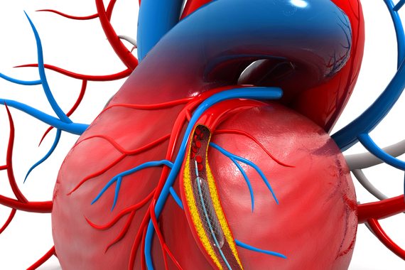 Diagram of angioplasty procedure, showing catheter being inserted into a coronary artery