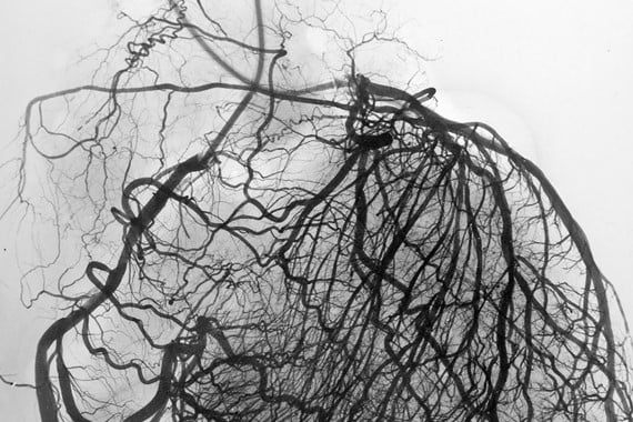 Image of detailed scan of the heart showing the large and small blood vessels supplying the heart muscle