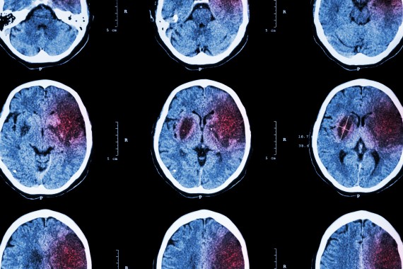 ct scan of the brain of a person who has had an ischaemic stroke