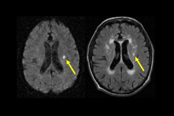 mri scans of the brain showing a lacunar stroke