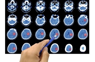 Scan of brain showing haemorrhage