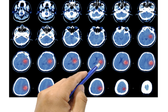 Doctor pointing at brain scan showing area of haemorrhage