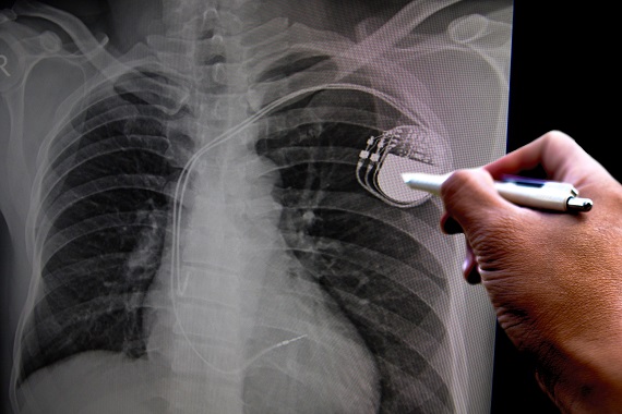 X-ray of a person's chest, showing a pacemaker fitted