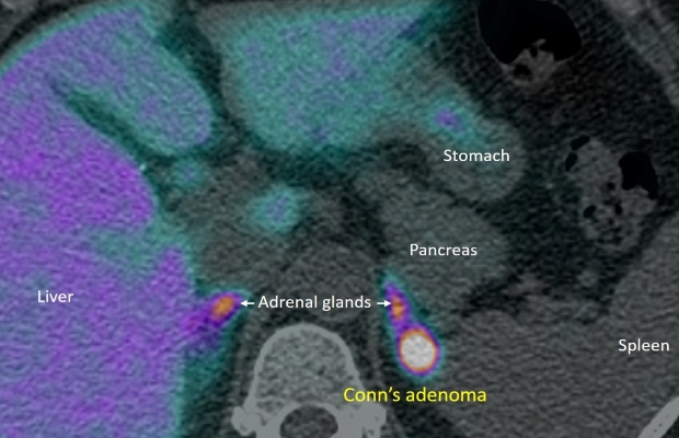 Conn's adenoma