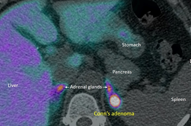 Conn's adenoma