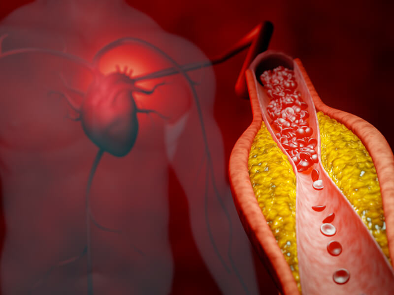 blood clot visualisation 