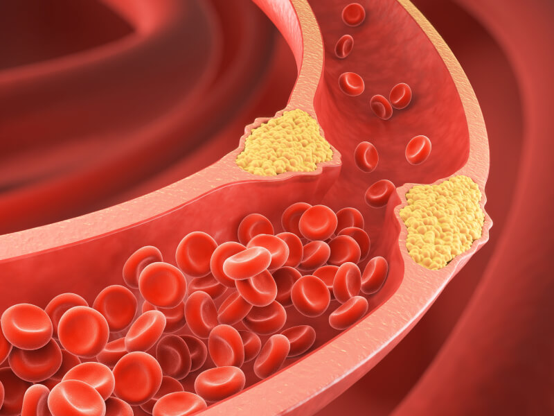 blood clot on the wall of a vessel 