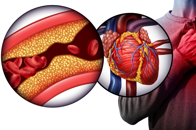 heart attack graphic