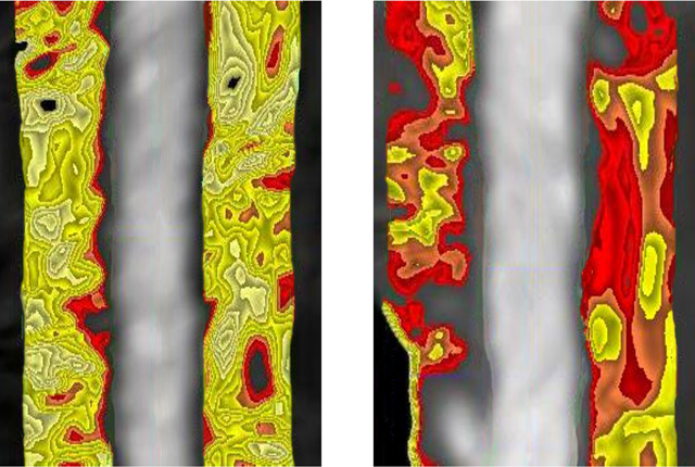 3D scan of an non inflamed artery, left, and an inflamed one on the right