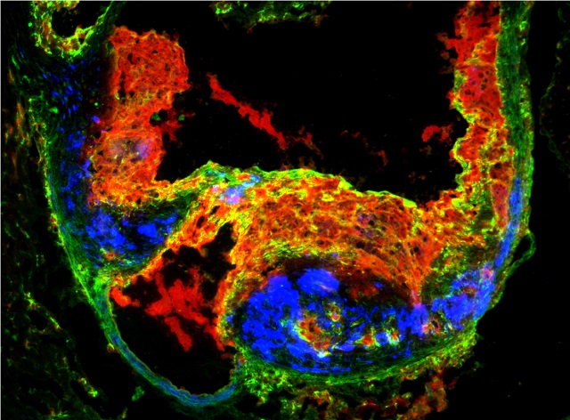 An atherosclerotic plaque forming within an artery
